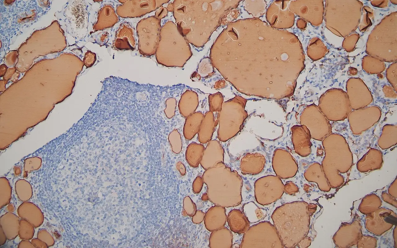 Thyroglobulin