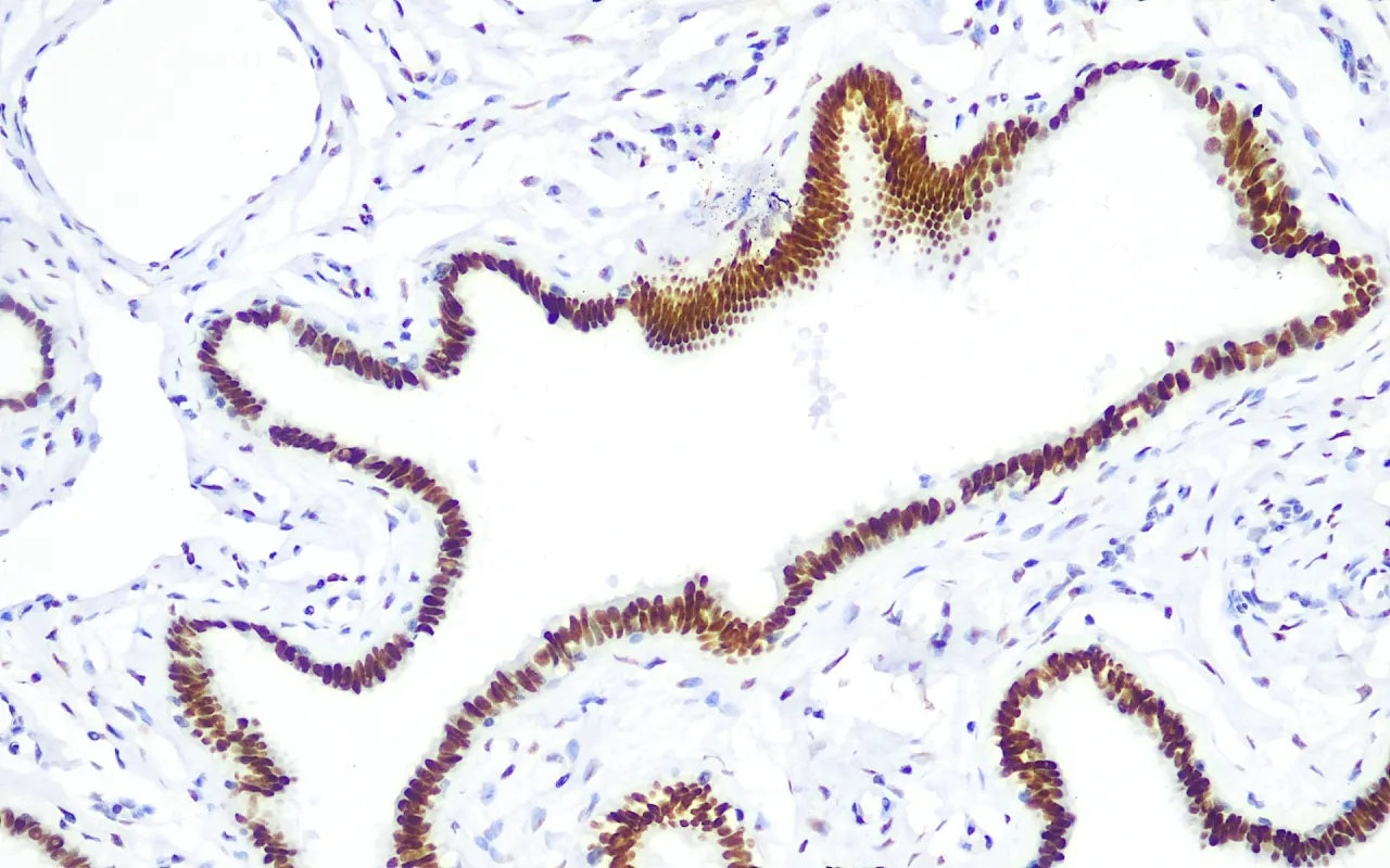 Wilms’ Tumor 1