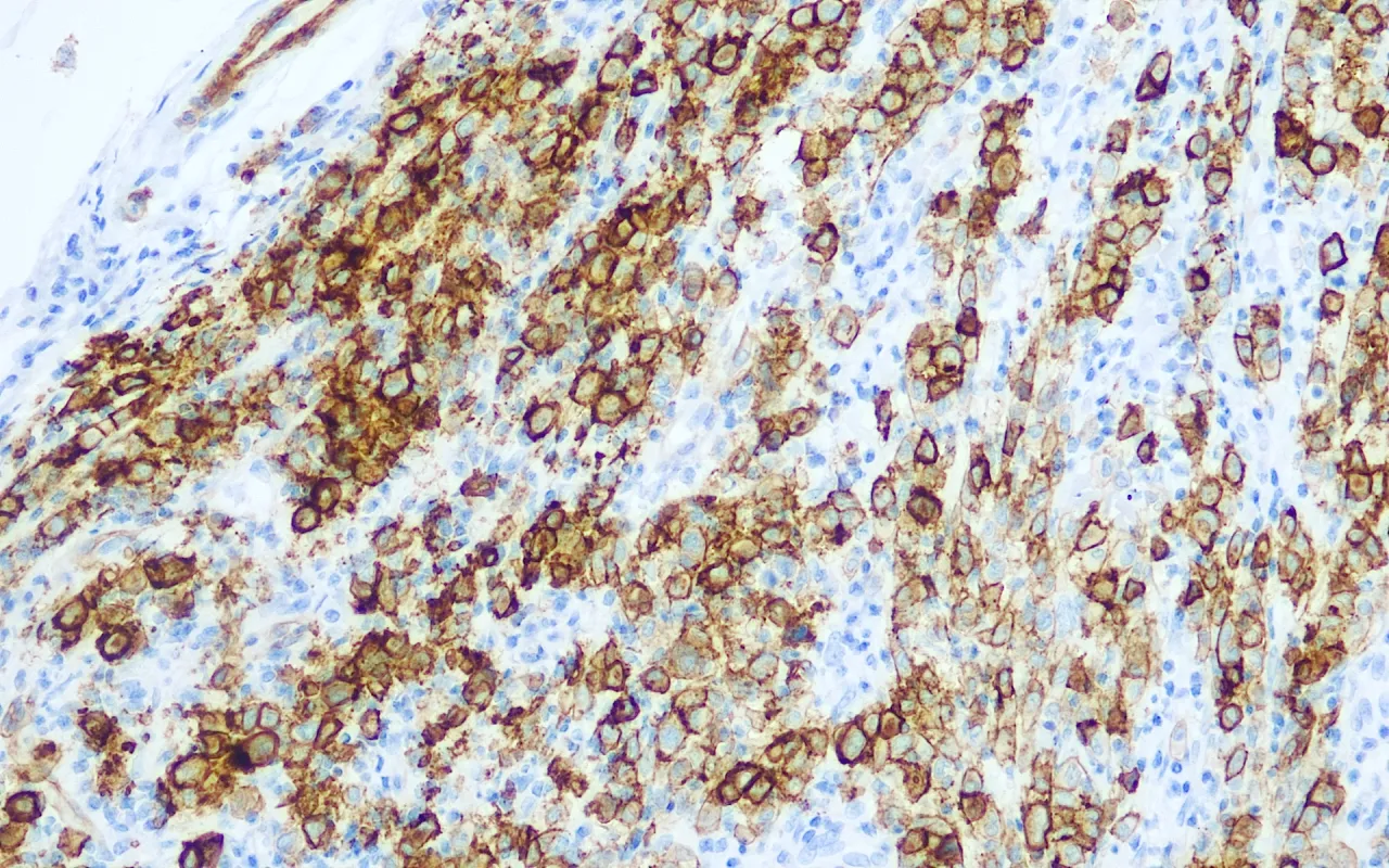 Melanoma Associated Antigen