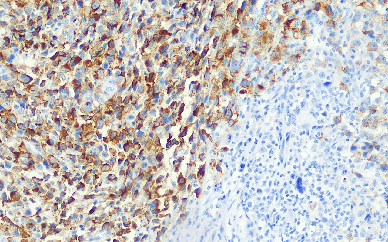 Melanoma