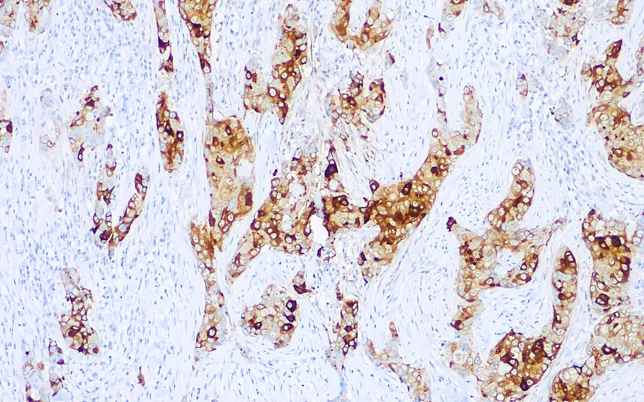 GCDFP-15