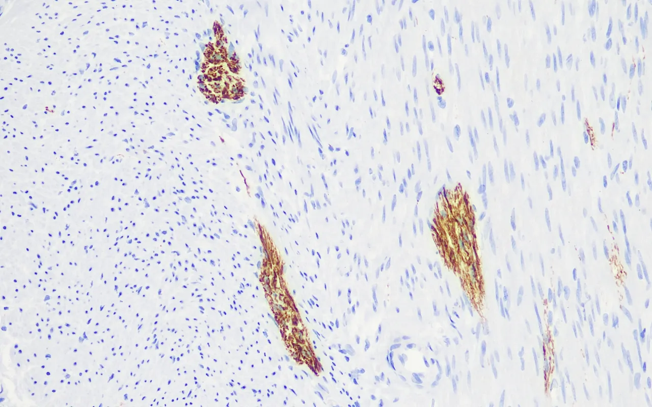 Neurofilament