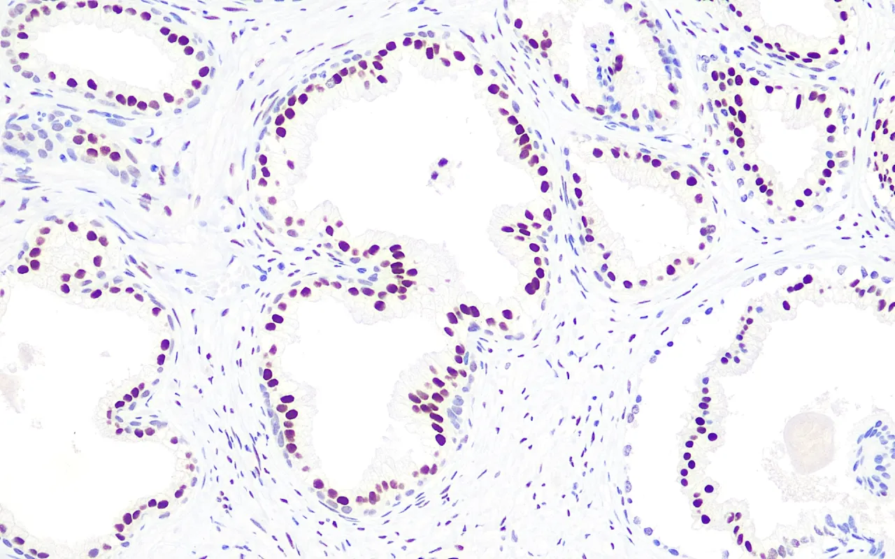 Androgen Receptor