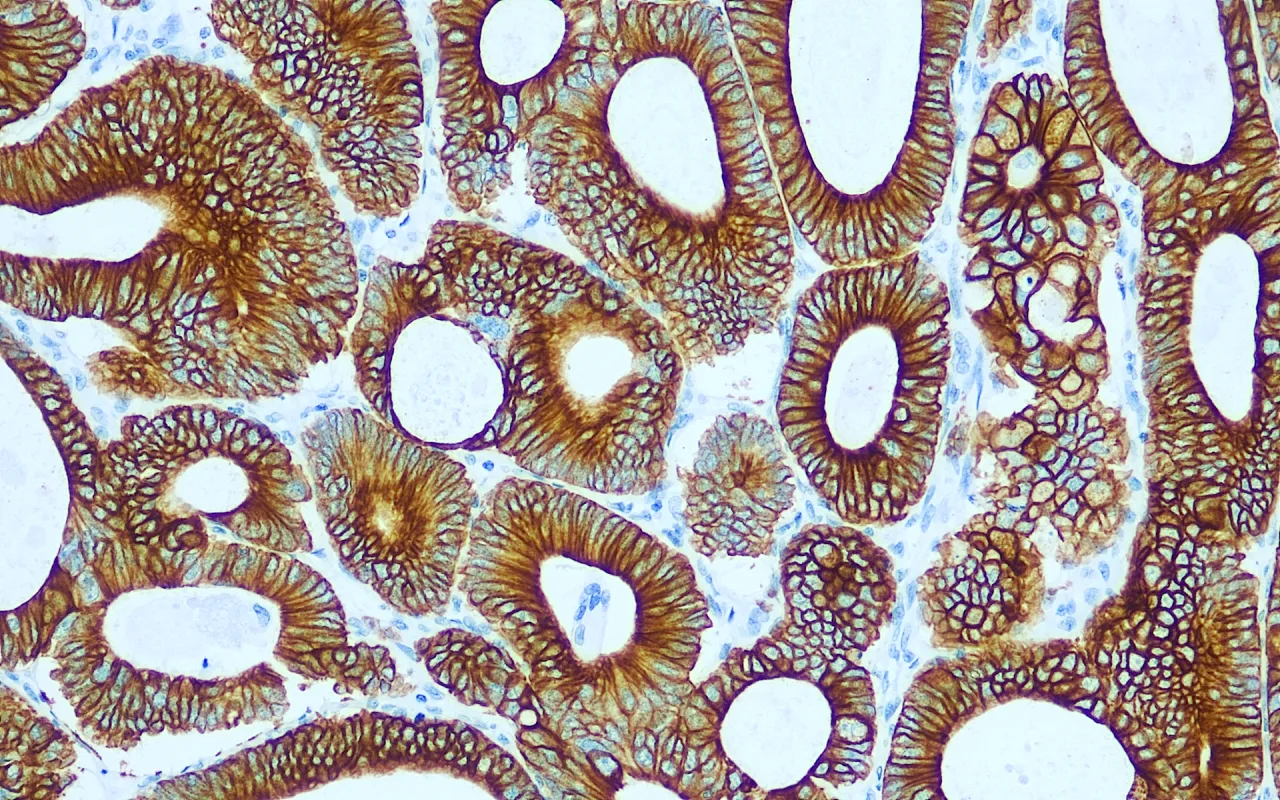 Cytokeratin 19