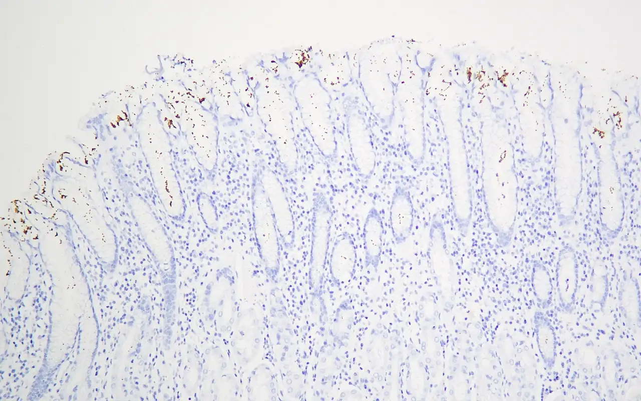Helicobacter pylori