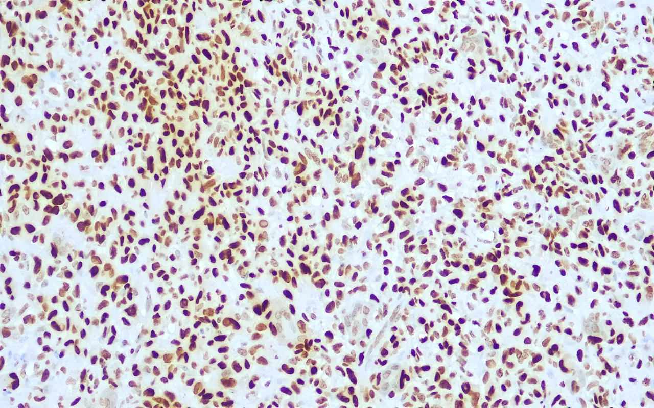Histone H3 K36M
