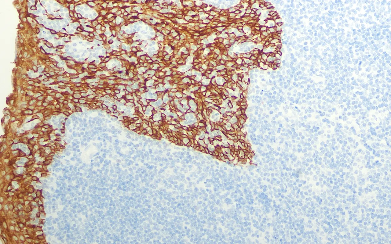 Cytokeratin Pan