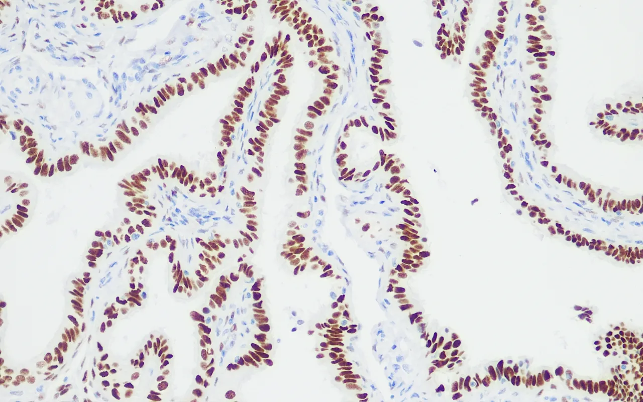 Wilms’ Tumor 1