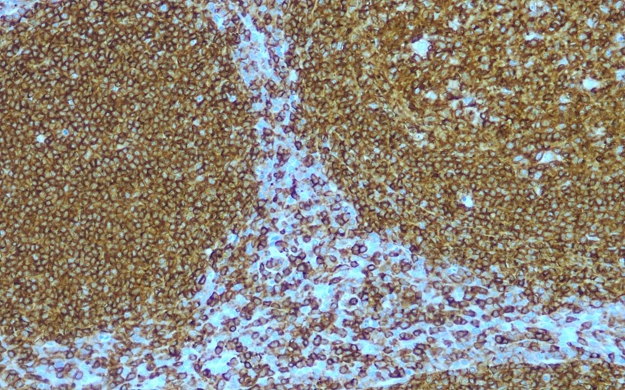 CD45/LCA
