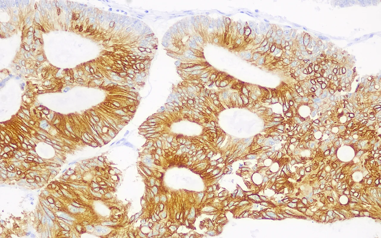 Cytokeratin 20