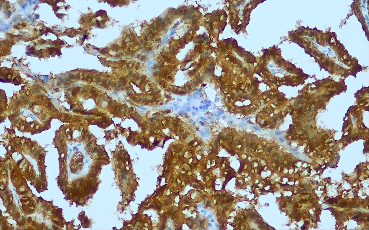 Galectin-3